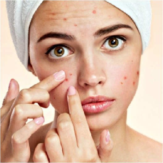 acne giovanile rimedi