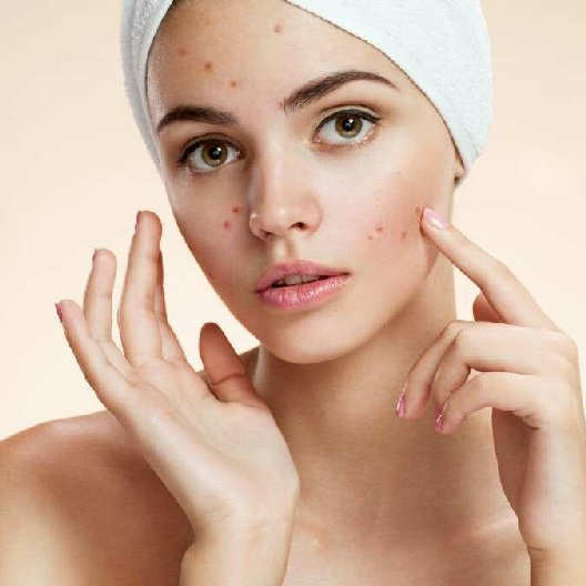 acne giovanile cause